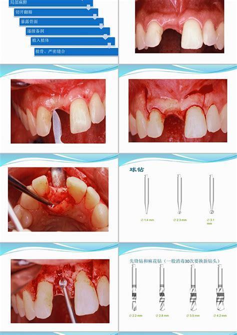 植牙手术中文版