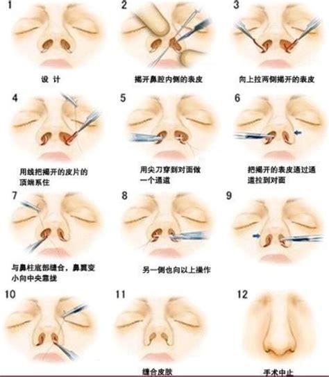 鼻科手术中文版